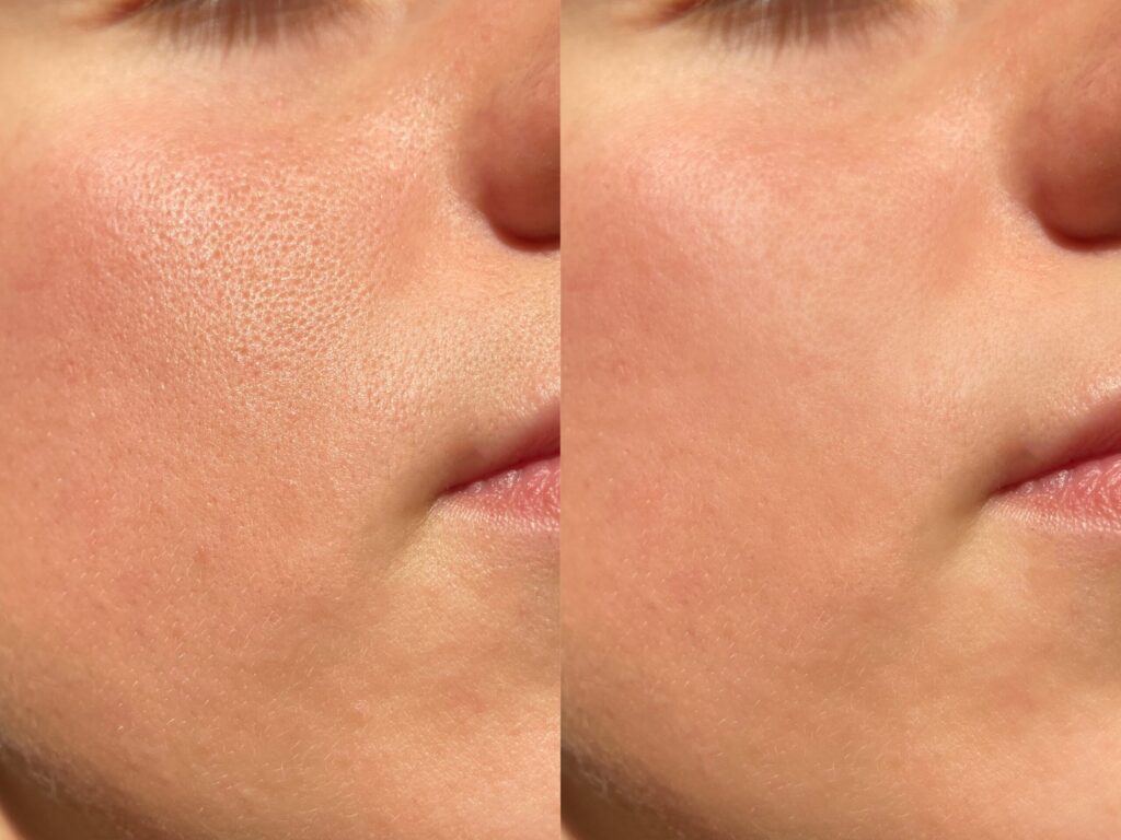 Microneedling