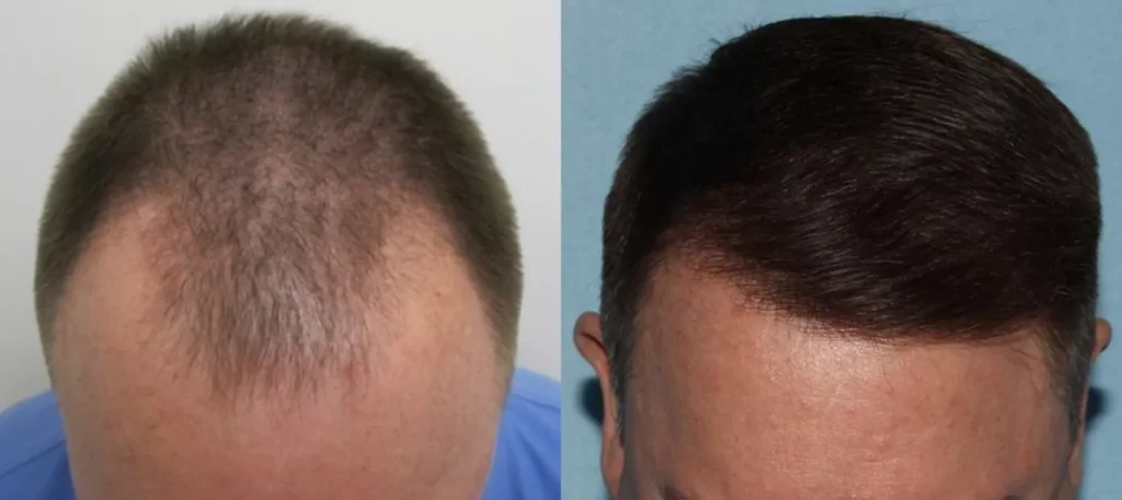 Hair Restoration with Smart Graft